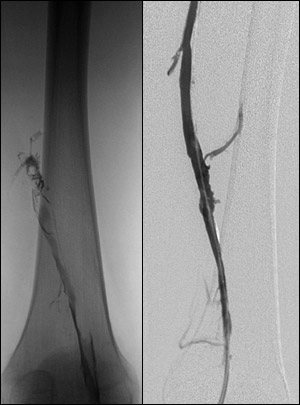 CT scans of repaired veins